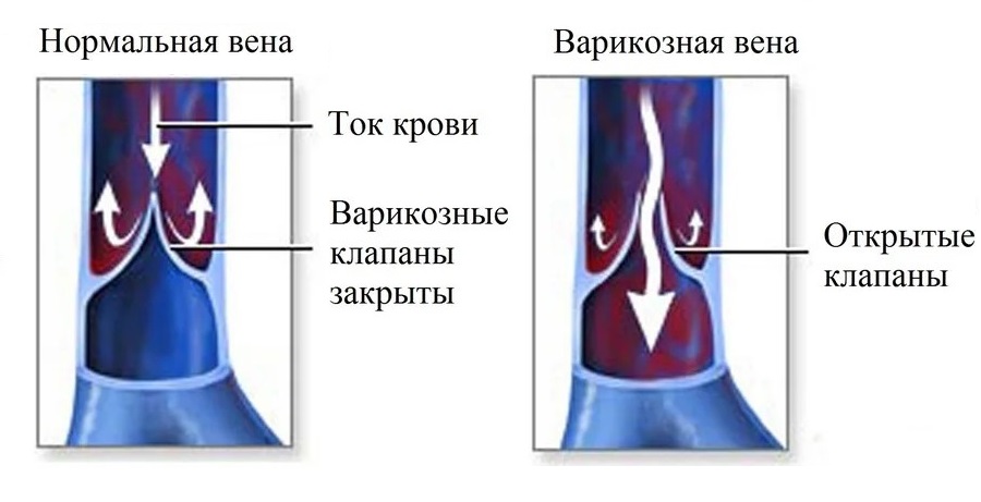 10 фактов о варикозе